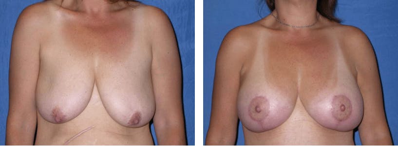 Breast Lift Before & After Gallery - Patient 74827470 - Image 1