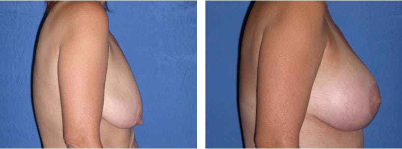 Breast Lift Before & After Gallery - Patient 74827470 - Image 2