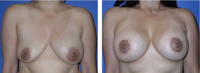 Breast Lift Before & After Gallery - Patient 74827471 - Image 1