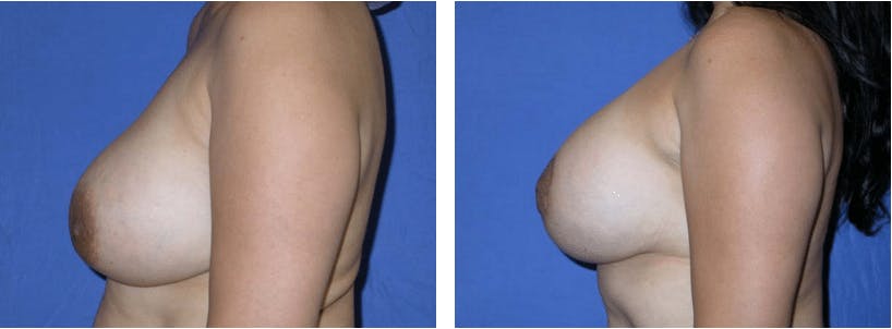Breast Lift Before & After Gallery - Patient 74827471 - Image 2