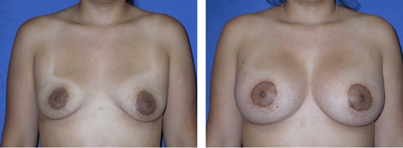 Breast Lift Before & After Gallery - Patient 74827500 - Image 1
