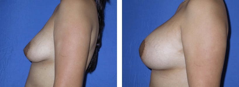 Breast Lift Before & After Gallery - Patient 74827500 - Image 2