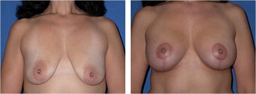 Breast Lift Before & After Gallery - Patient 74827501 - Image 1