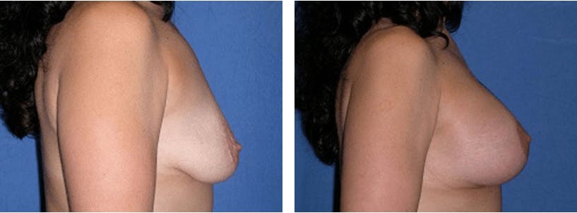 Breast Lift Before & After Gallery - Patient 74827501 - Image 2