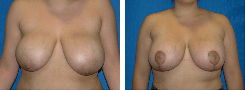 Breast Lift Before & After Gallery - Patient 74827502 - Image 1