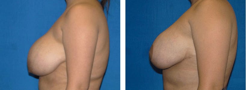 Breast Lift Before & After Gallery - Patient 74827502 - Image 2