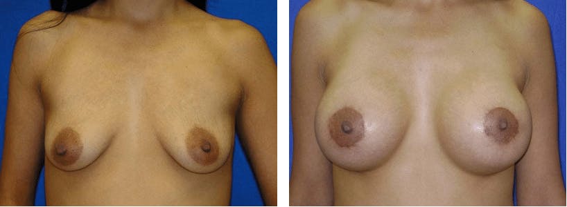 Breast Lift Before & After Gallery - Patient 74827503 - Image 1