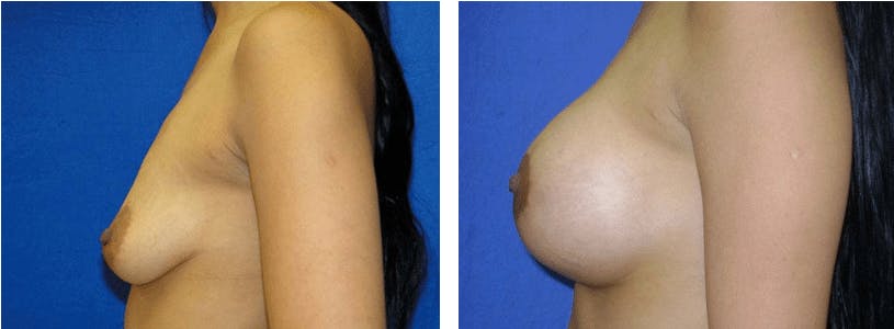 Breast Lift Gallery - Patient 74827503 - Image 2