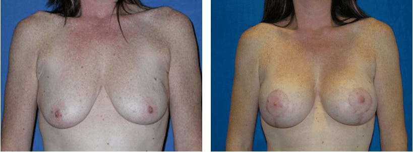 Breast Lift Before & After Gallery - Patient 74827504 - Image 1