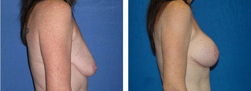 Breast Lift Before & After Gallery - Patient 74827504 - Image 2