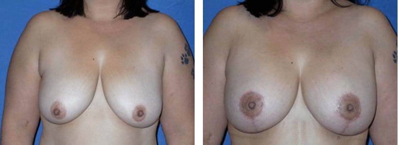 Breast Lift Before & After Gallery - Patient 74827505 - Image 1