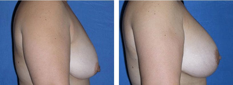 Breast Lift Before & After Gallery - Patient 74827505 - Image 2
