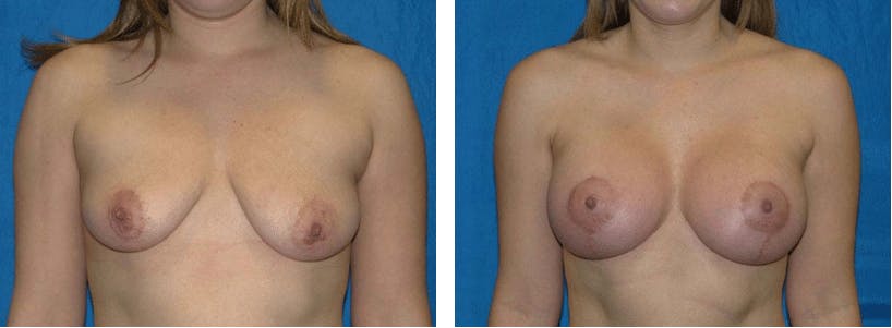 Breast Lift Before & After Gallery - Patient 74827506 - Image 1