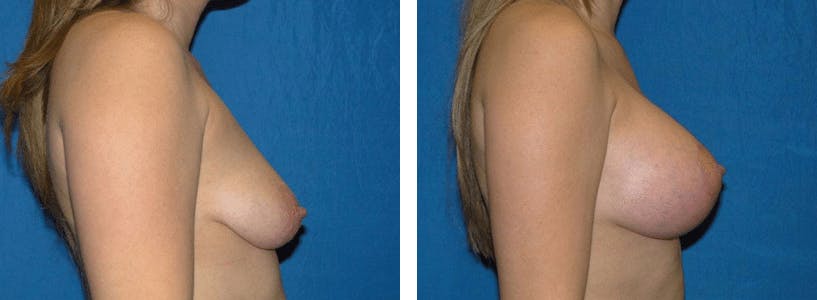 Breast Lift Before & After Gallery - Patient 74827506 - Image 2