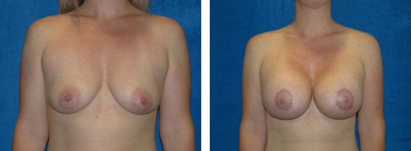Breast Lift Before & After Gallery - Patient 74827507 - Image 1