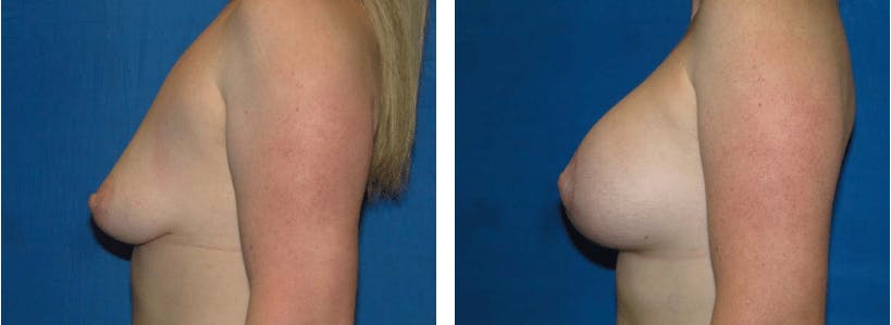 Breast Lift Before & After Gallery - Patient 74827507 - Image 2
