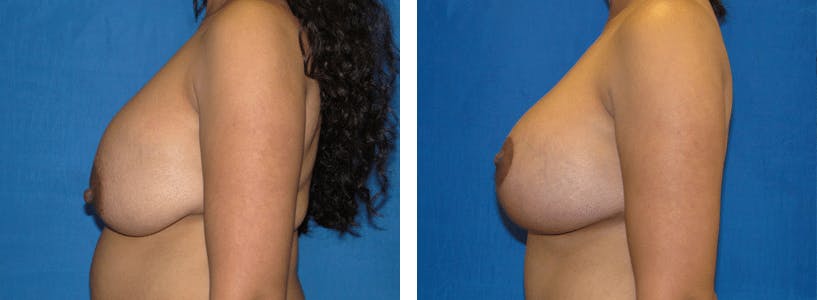 Breast Lift Before & After Gallery - Patient 74827508 - Image 2