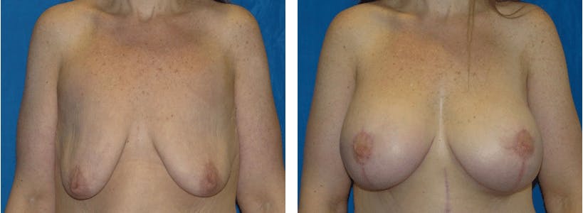 Breast Lift Before & After Gallery - Patient 74827509 - Image 1