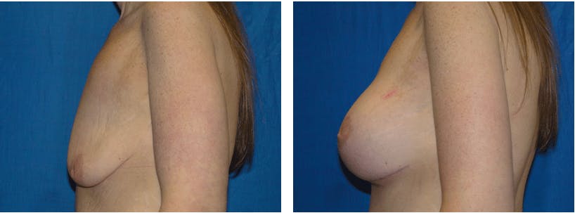Breast Lift Before & After Gallery - Patient 74827509 - Image 2