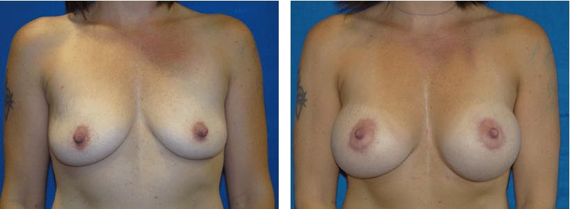 Breast Lift Before & After Gallery - Patient 74827510 - Image 1