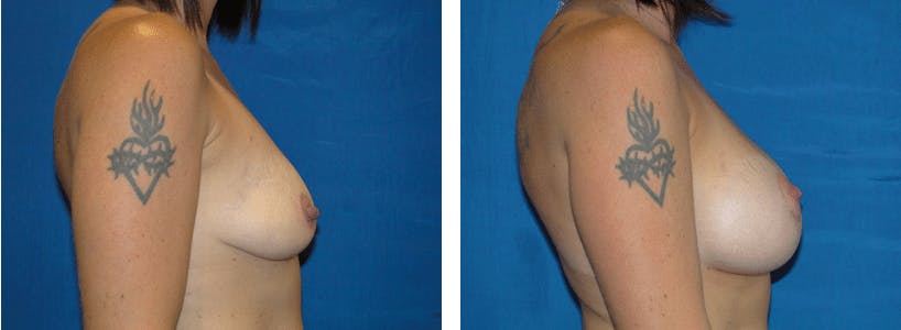 Breast Lift Before & After Gallery - Patient 74827510 - Image 2