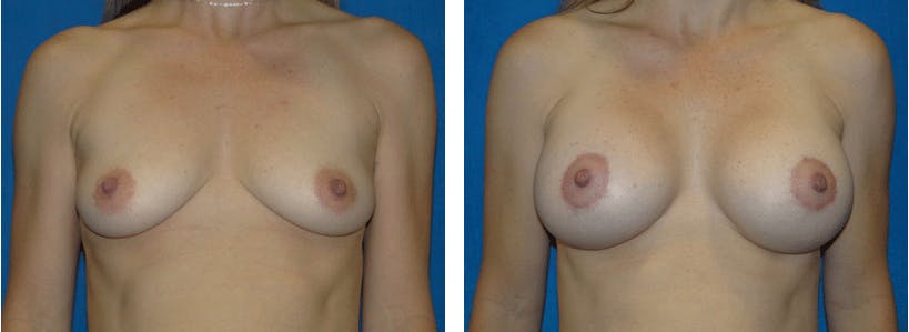 Breast Lift Before & After Gallery - Patient 74827511 - Image 1