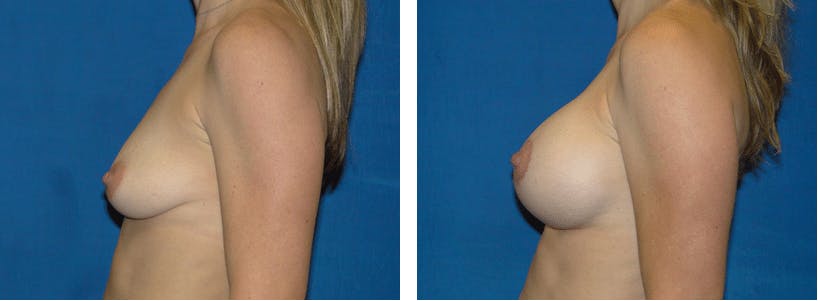 Breast Lift Before & After Gallery - Patient 74827511 - Image 2