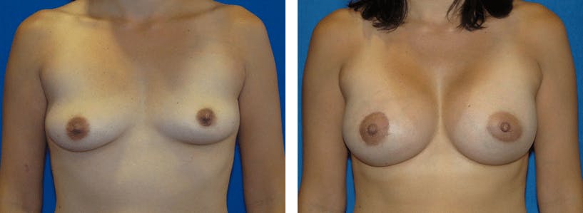 Breast Lift Before & After Gallery - Patient 74827512 - Image 1