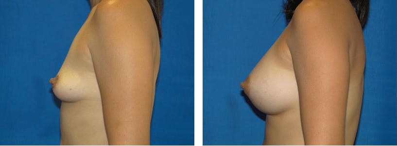 Breast Lift Before & After Gallery - Patient 74827512 - Image 2