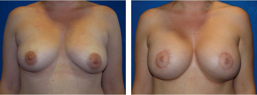 Breast Lift Before & After Gallery - Patient 74827513 - Image 1
