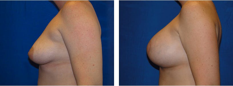 Breast Lift Before & After Gallery - Patient 74827513 - Image 2