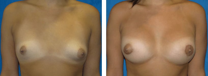 Breast Lift Before & After Gallery - Patient 74827514 - Image 1