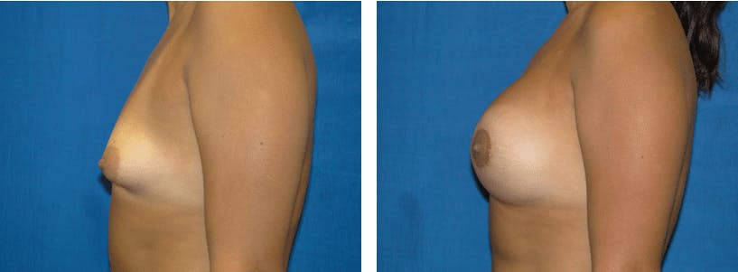 Breast Lift Before & After Gallery - Patient 74827514 - Image 2