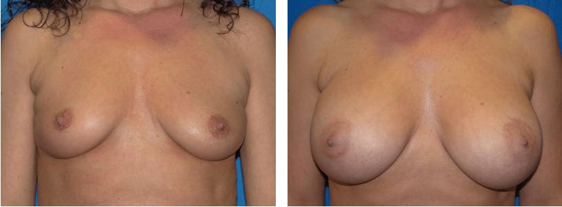 Breast Lift Before & After Gallery - Patient 74827515 - Image 1