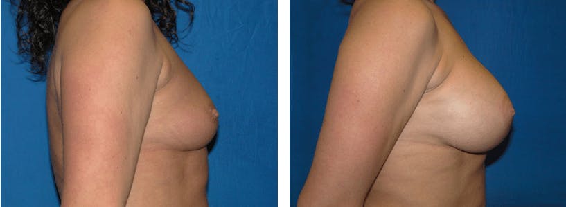Breast Lift Before & After Gallery - Patient 74827515 - Image 2
