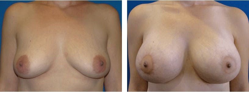 Breast Lift Before & After Gallery - Patient 74827516 - Image 1