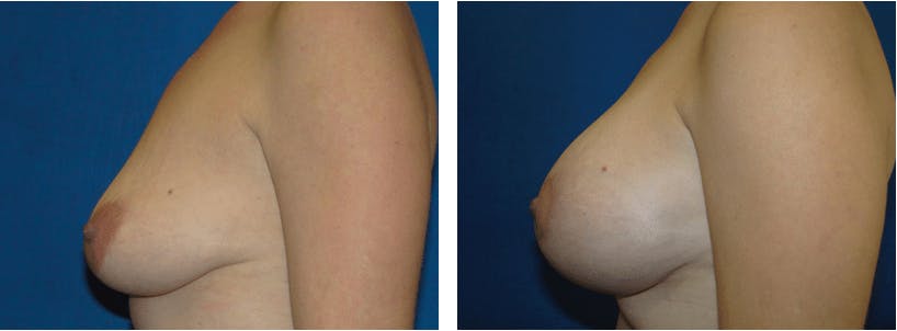 Breast Lift Before & After Gallery - Patient 74827516 - Image 2
