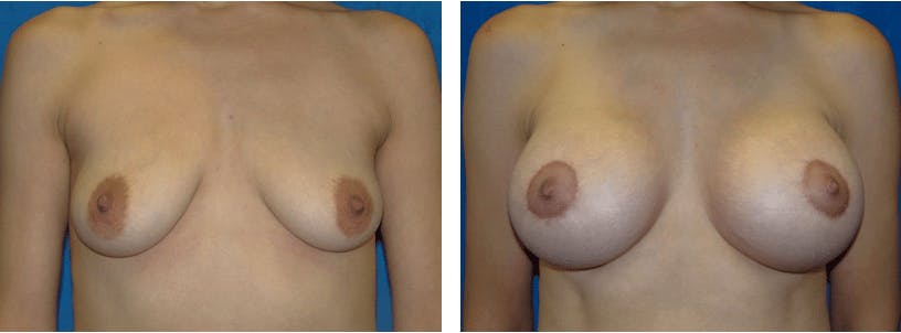 Breast Lift Gallery - Patient 74827517 - Image 1