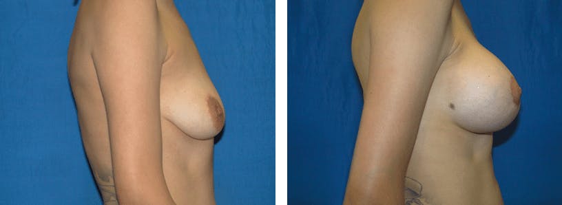Breast Lift Before & After Gallery - Patient 74827517 - Image 2
