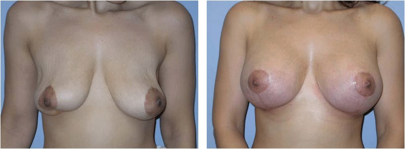 Breast Augmentation Revision