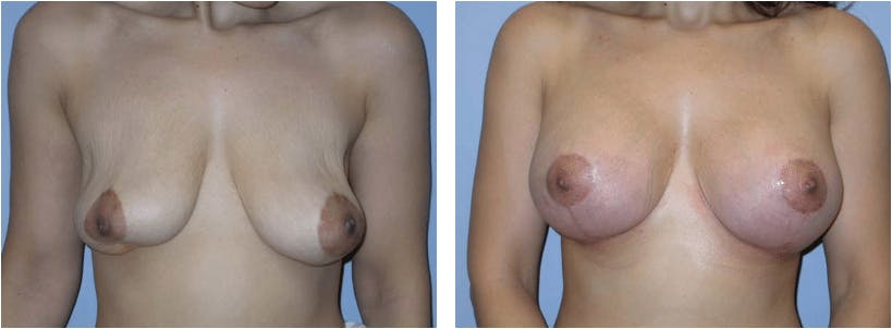 Breast Revision Before & After Gallery - Patient 74827519 - Image 1