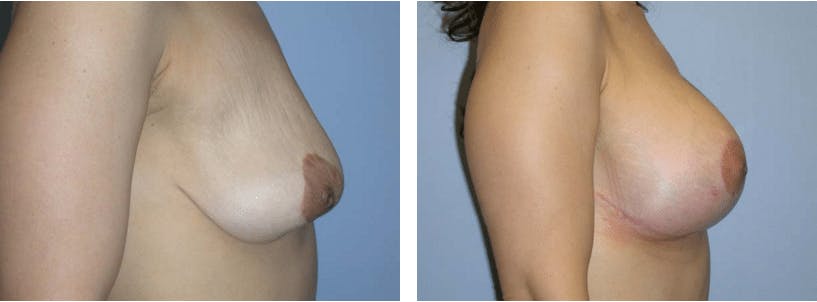 Breast Revision Before & After Gallery - Patient 74827519 - Image 2