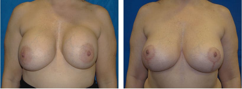 Breast Revision Before & After Gallery - Patient 74827520 - Image 1
