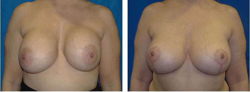 Breast Revision Before & After Gallery - Patient 74827520 - Image 1