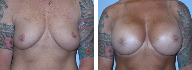 Breast Revision Before & After Gallery - Patient 74827522 - Image 1