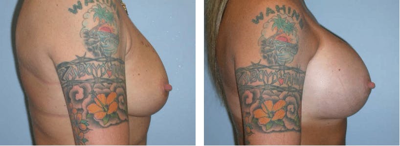 Breast Revision Before & After Gallery - Patient 74827522 - Image 2