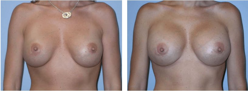 Breast Revision Before & After Gallery - Patient 74827523 - Image 1