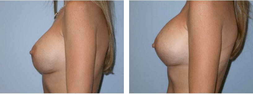 Breast Revision Before & After Gallery - Patient 74827523 - Image 2