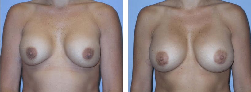Breast Revision Before & After Gallery - Patient 74827524 - Image 1