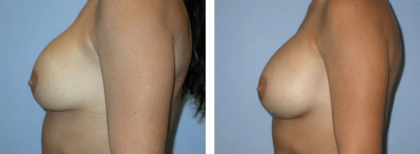 Breast Revision Before & After Gallery - Patient 74827524 - Image 2